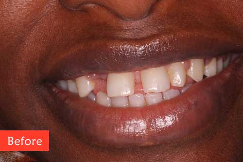 Before Composite Build up and Bridges Treatment