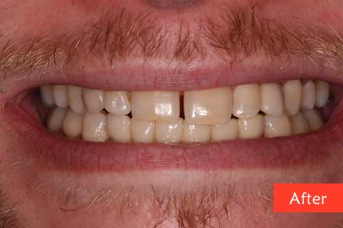 after dental implants 