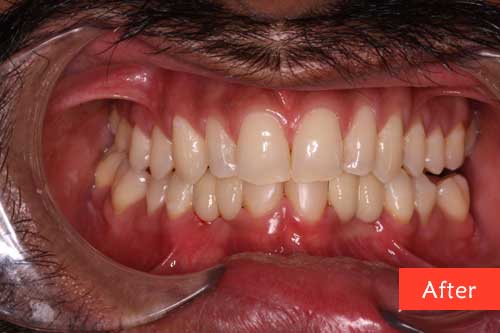 After Composite Build up and Bridges Treatment