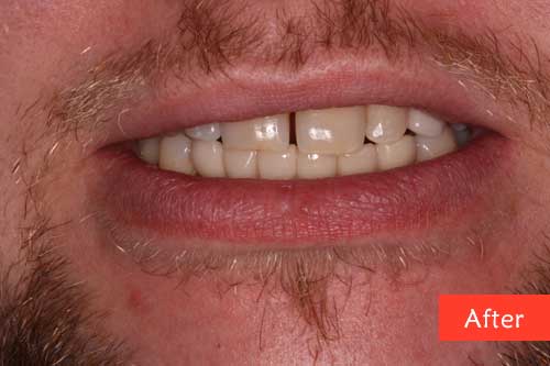 after dental implants
