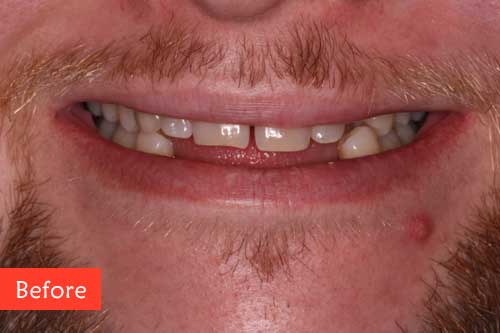 Before dental implants