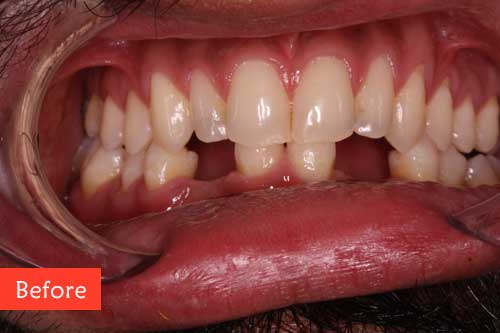 Before Composite Build up and Bridges Treatment