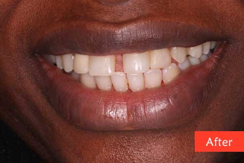 Afer Composite Build up and Bridges Trearment