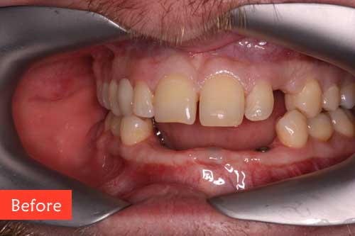 Before dental implants